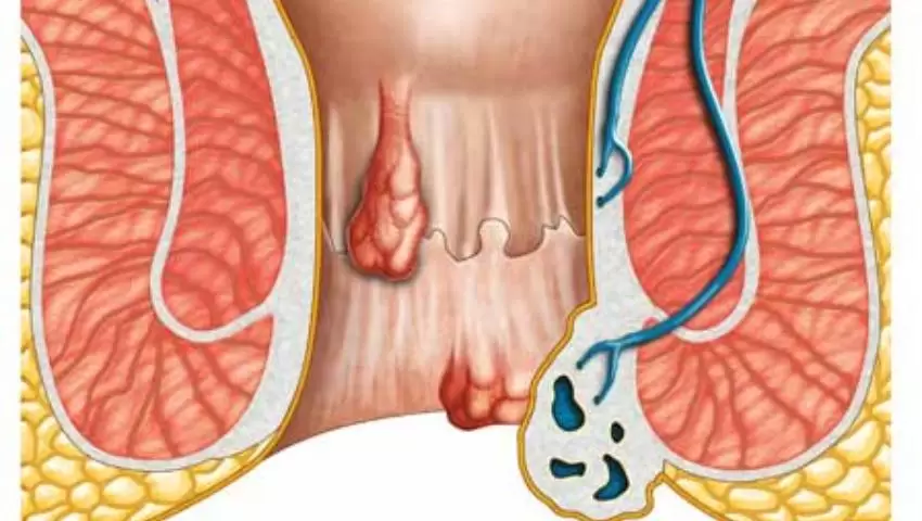 Fistula Treatment